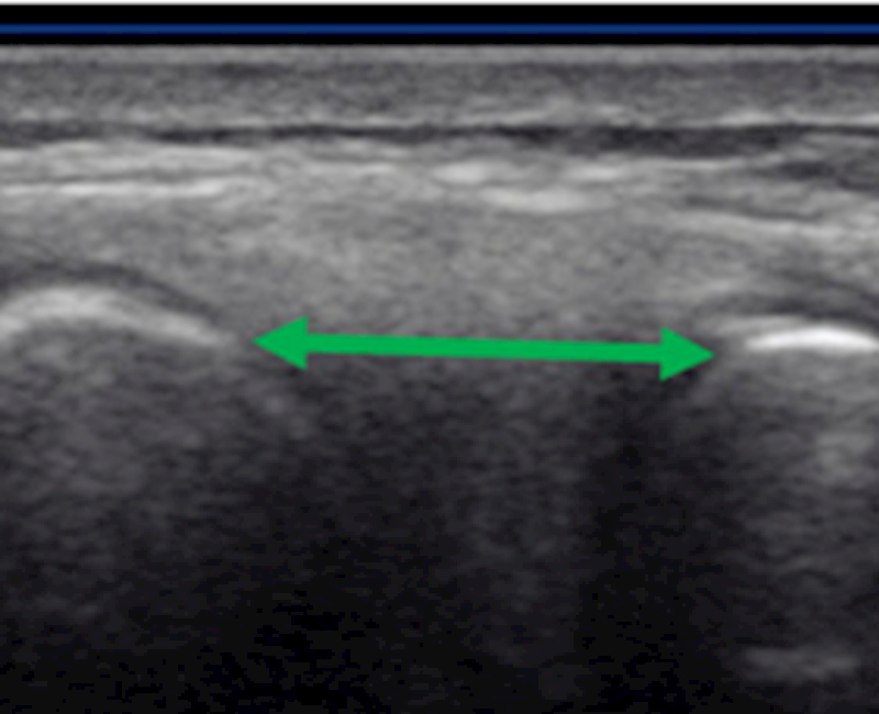 The medial knee gap measured on ultrasound images is wider during a valgus stress test compared to the anterior medial knee rotation test